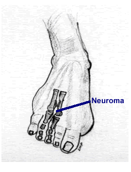Neuroma - drawing by S. Pribut